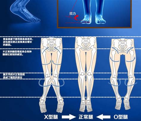 走路外八字|走路外八字怎么矫正